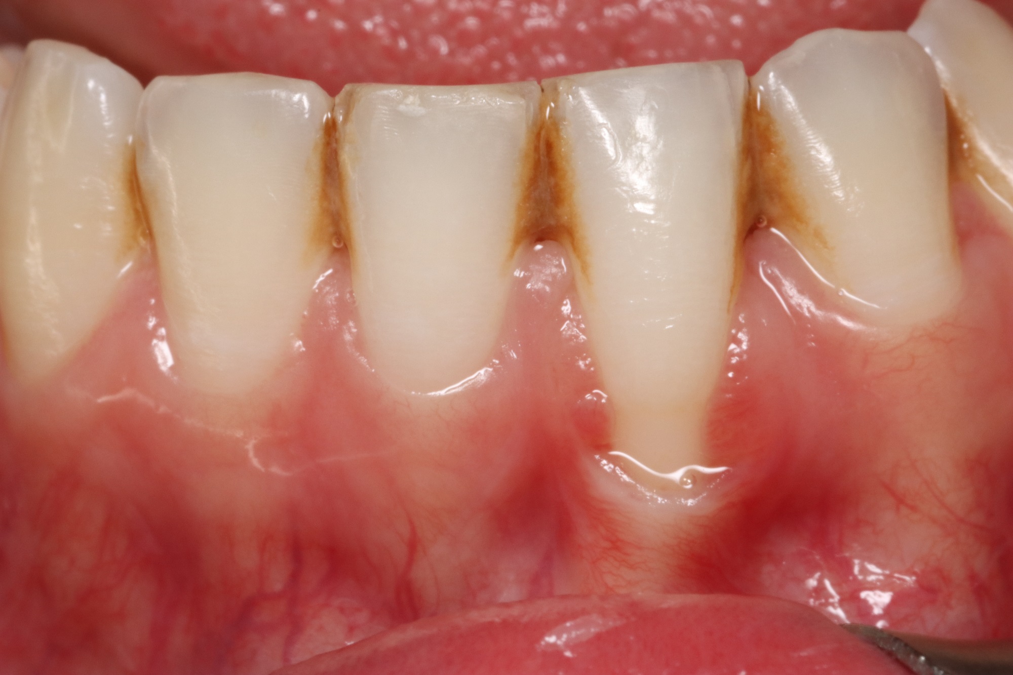 Gum recession treatment — before treatment