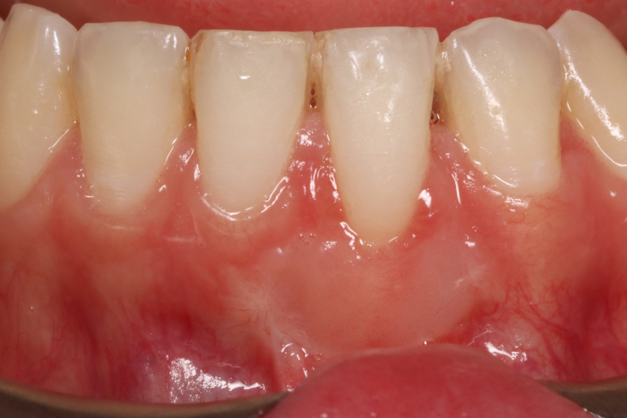Gum recession treatment — after treatment